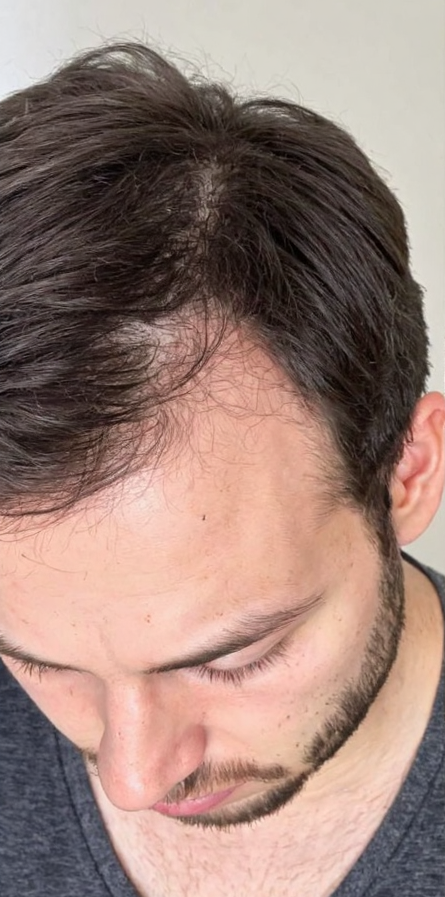 Antes